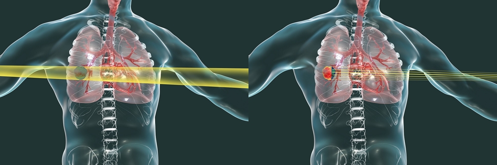 X-ray (left) and heavy-ion beams (right). Heavy ion beams stop at the tumor, minimizing damage to normal tissue.