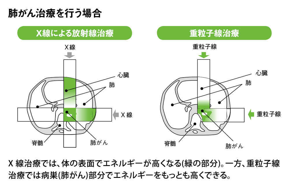 重粒子線治療は「身体の深いところ」にあるがんの治療にも有効