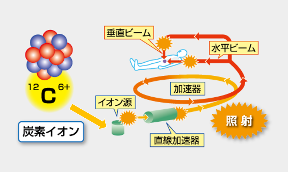 炭素イオンを照射する仕組み